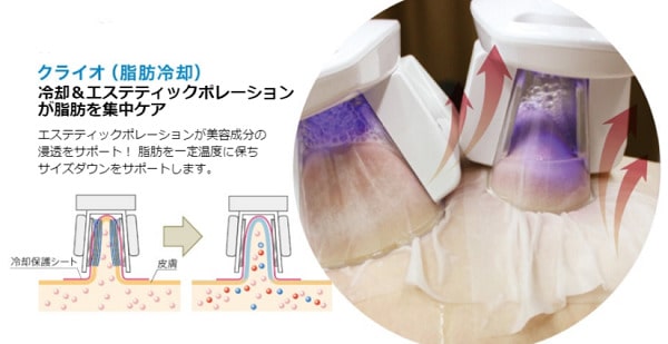 脂肪冷却ダイエット